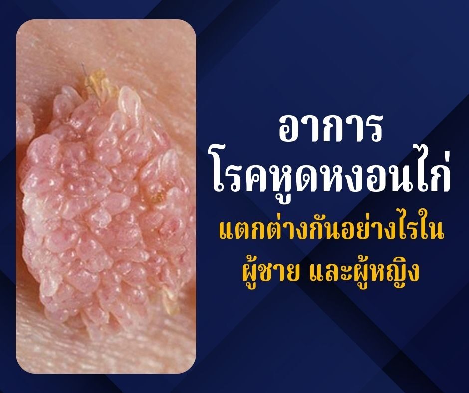 อาการโรคหูดหงอนไก่ แตกต่างกันอย่างไรในผู้ชาย และผู้หญิง
