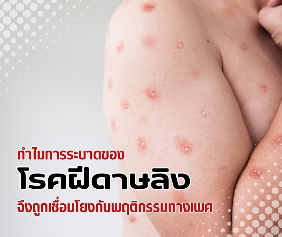 ทำไมการระบาดของโรคฝีดาษลิงจึงถูกเชื่อมโยงกับพฤติกรรมทางเพศ