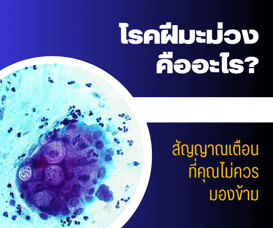 โรคฝีมะม่วง คืออะไร? สัญญาณเตือนที่คุณไม่ควรมองข้าม