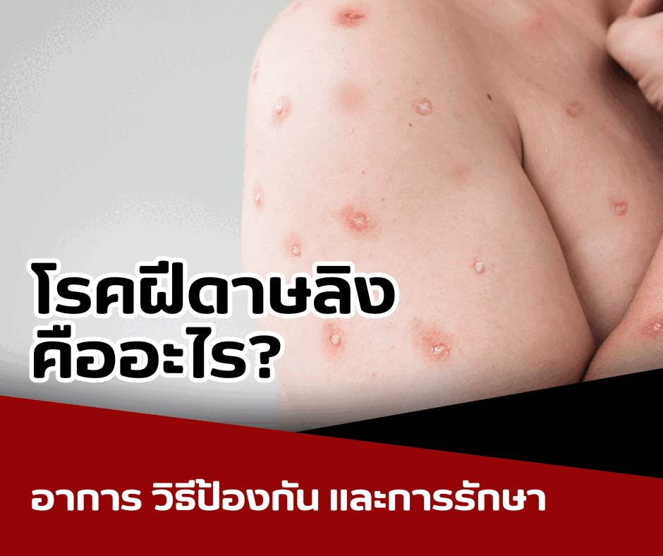 โรคฝีดาษลิง คืออะไร? อาการ วิธีป้องกัน และการรักษา