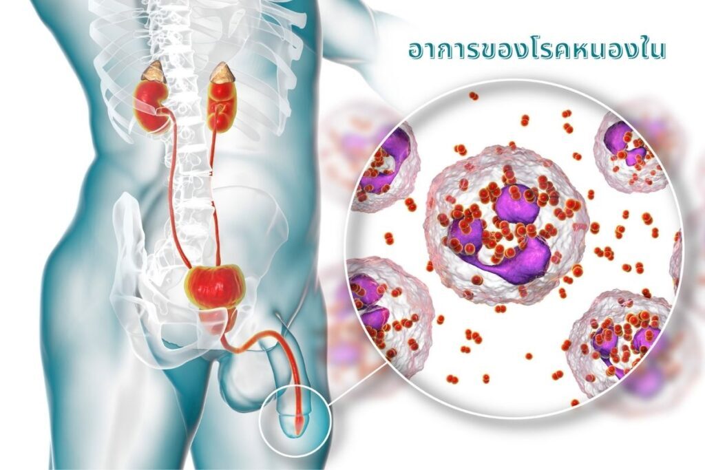 โรคหนองใน (Gonorrhoea)