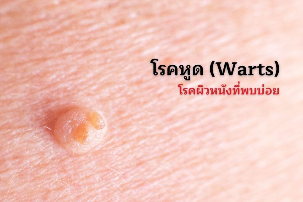 โรคหูด (Warts) โรคผิวหนังที่พบบ่อย