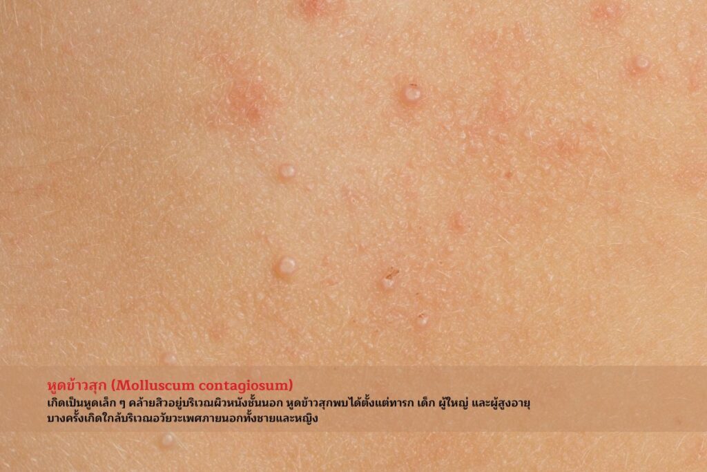 โรคหูด-หูดข้าวสุก