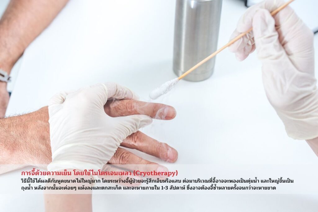 โรคหูด-ใช้ไนโตรเจนเหลว