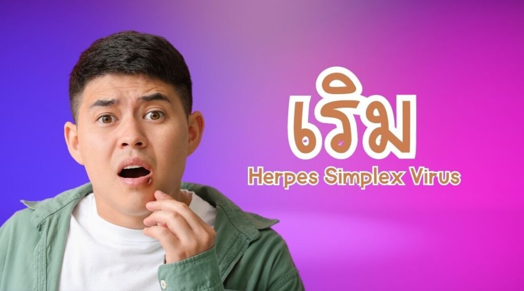 เริม | Herpes Simplex Virus