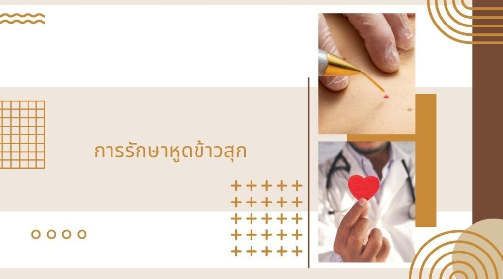 การรักษา หูดข้าวสุก