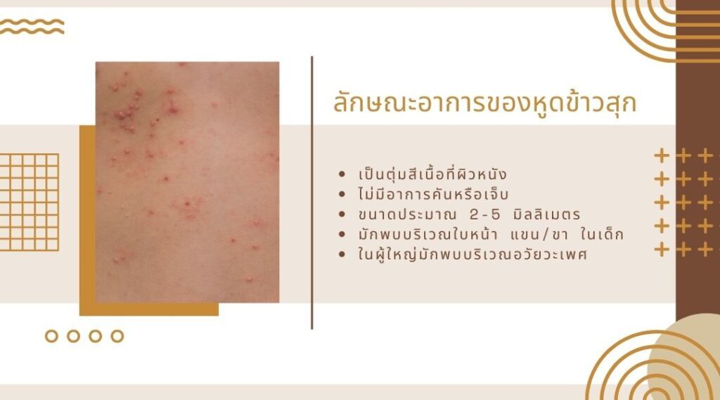 ลักษณะอาการของหูดข้าวสุก