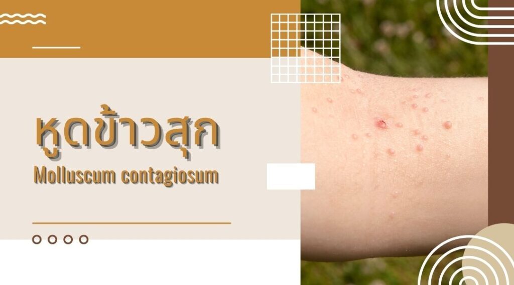หูดข้าวสุก | Molluscum contagiosum