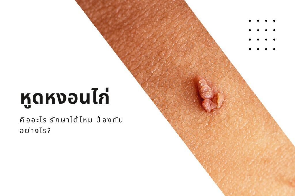 หูดหงอนไก่ คืออะไร รักษาได้ไหม ป้องกันยังไง?
