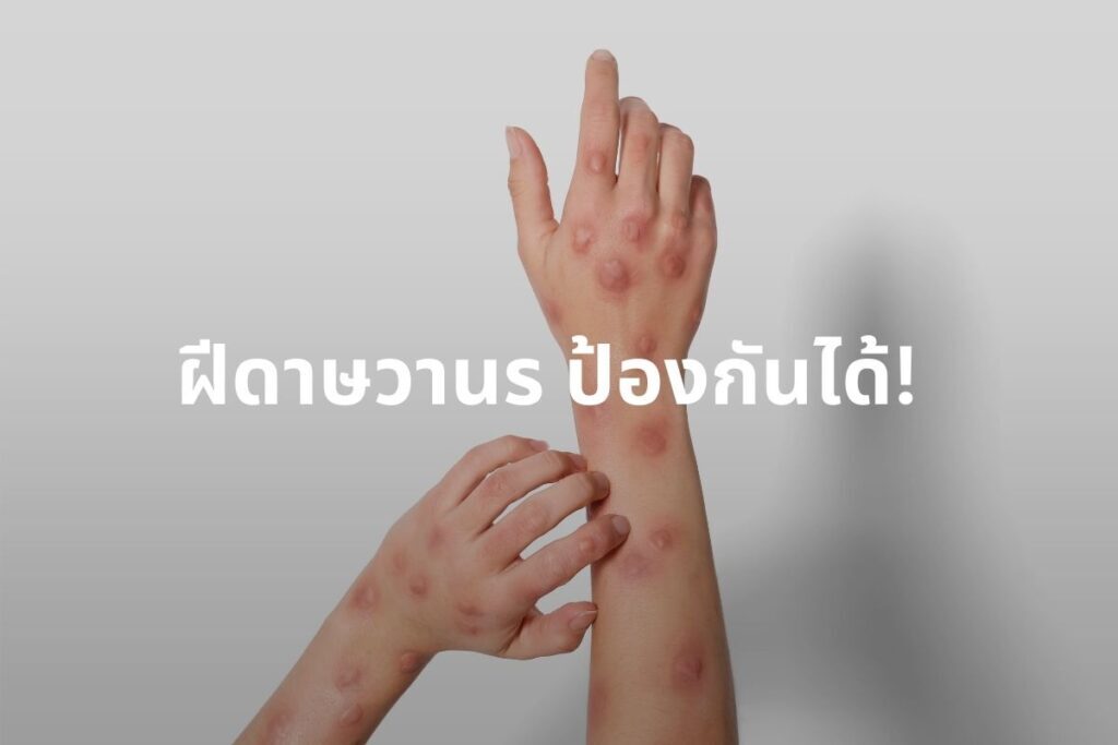 ฝีดาษวานร
