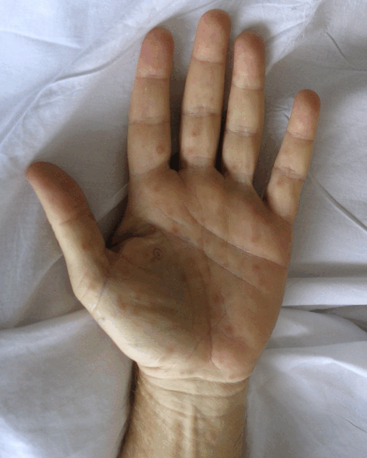 ซิฟิลิส Syphilis คืออะไร
