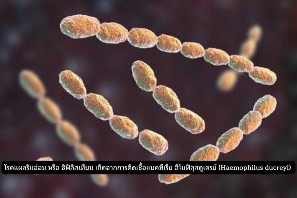 Haemophilus ducreyi