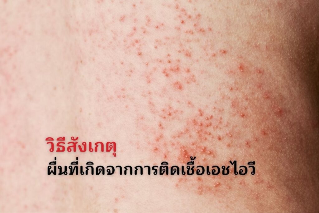 วิธีสังเกตุผื่นที่เกิดจากการติดเชื้อเอชไอวี