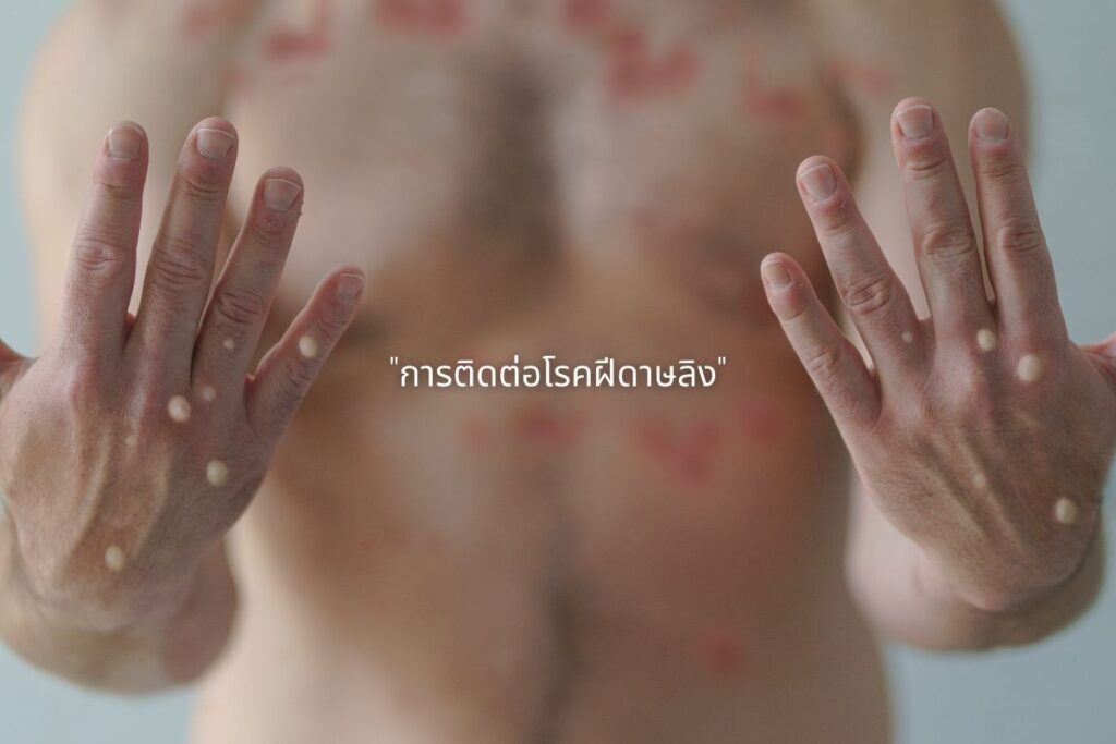 การติดต่อโรคฝีดาษลิง