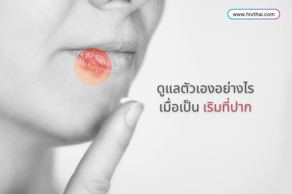 ดูแลตัวเองอย่างไรเมื่อเป็น เริมที่ปาก