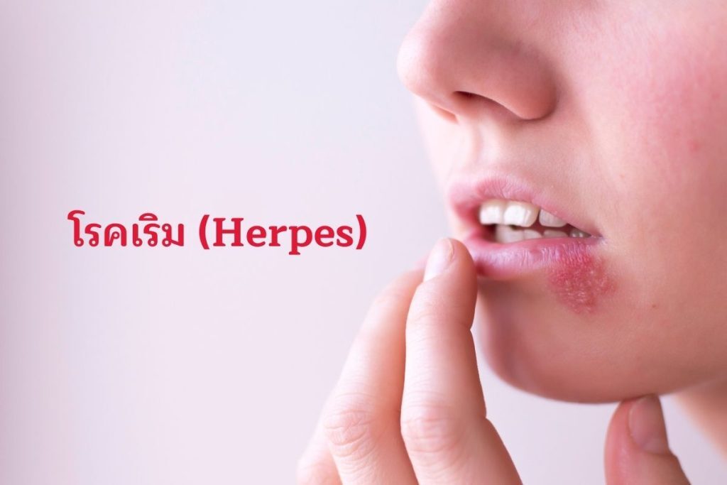 โรคเริม (Herpes)