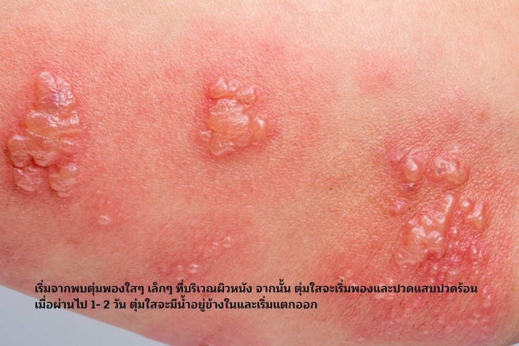 ตุ่มพองใสๆ