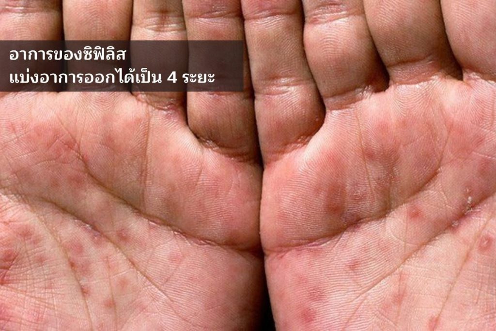 อาการของซิฟิลิส