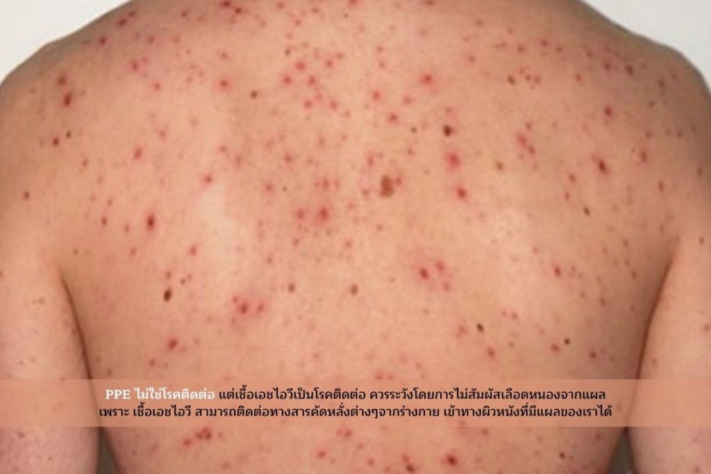 ตุ่มPPEไม่ใช่โรคติดต่อ
