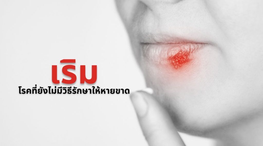 เริม..โรคที่ยังไม่มีวิธีรักษาให้หายขาด