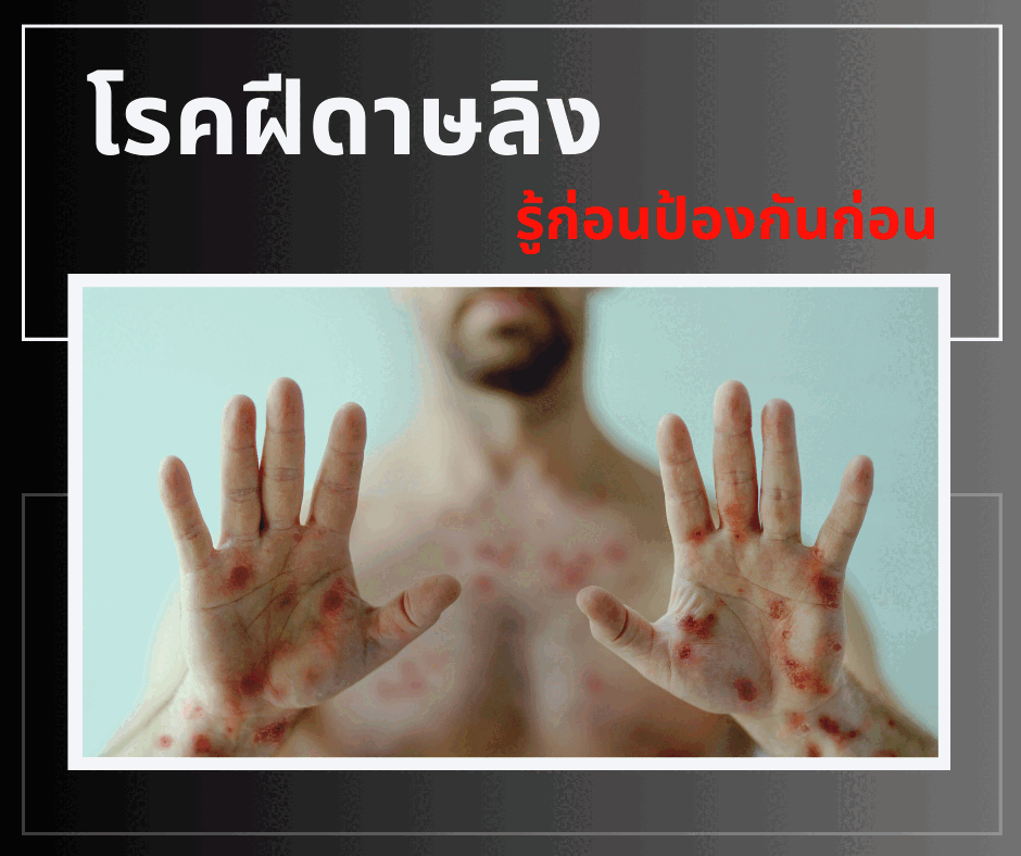 โรคฝีดาษลิง รู้ก่อนป้องกันก่อน
