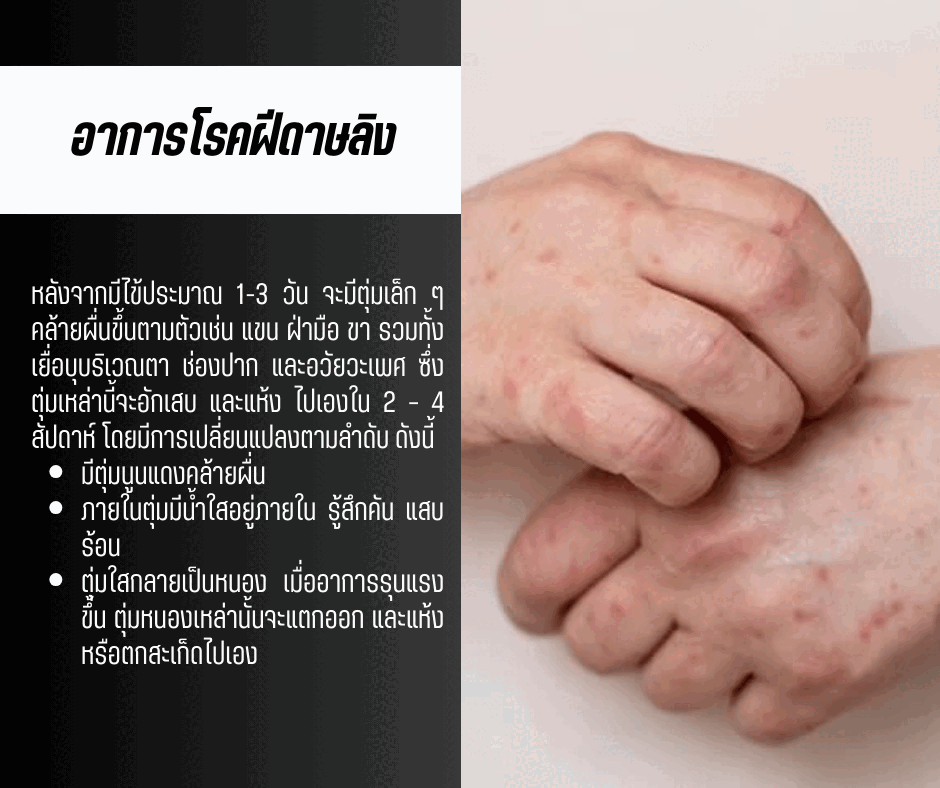 อาการโรคฝีดาษลิง