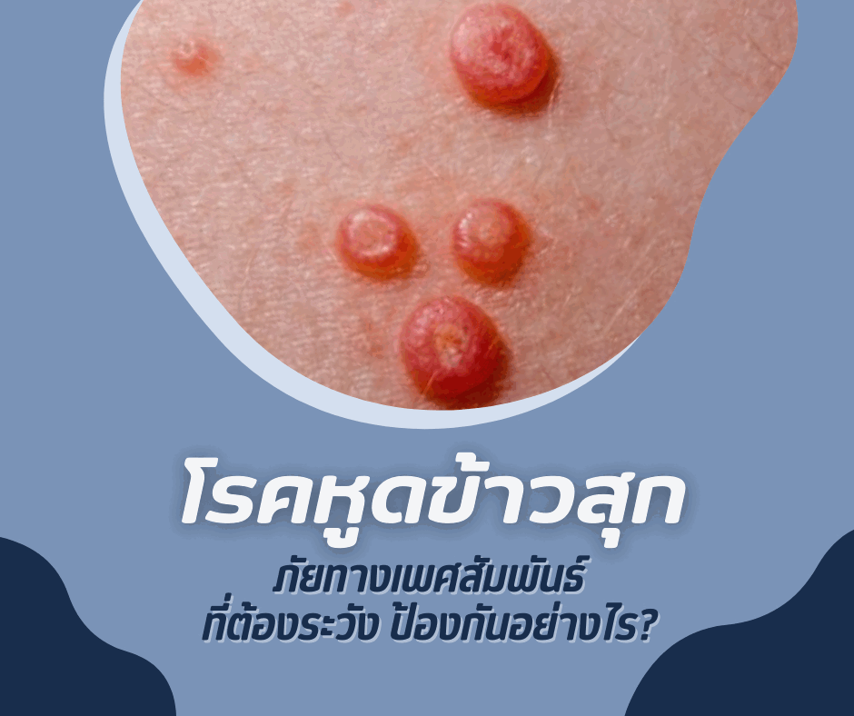 โรคหูดข้าวสุก : ภัยทางเพศสัมพันธ์ที่ต้องระวัง ป้องกันอย่างไร?