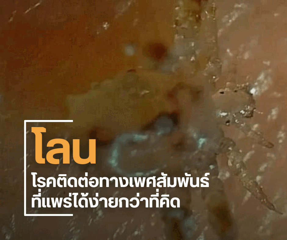 โลน : โรคติดต่อทางเพศสัมพันธ์ที่แพร่ได้ง่ายกว่าที่คิด