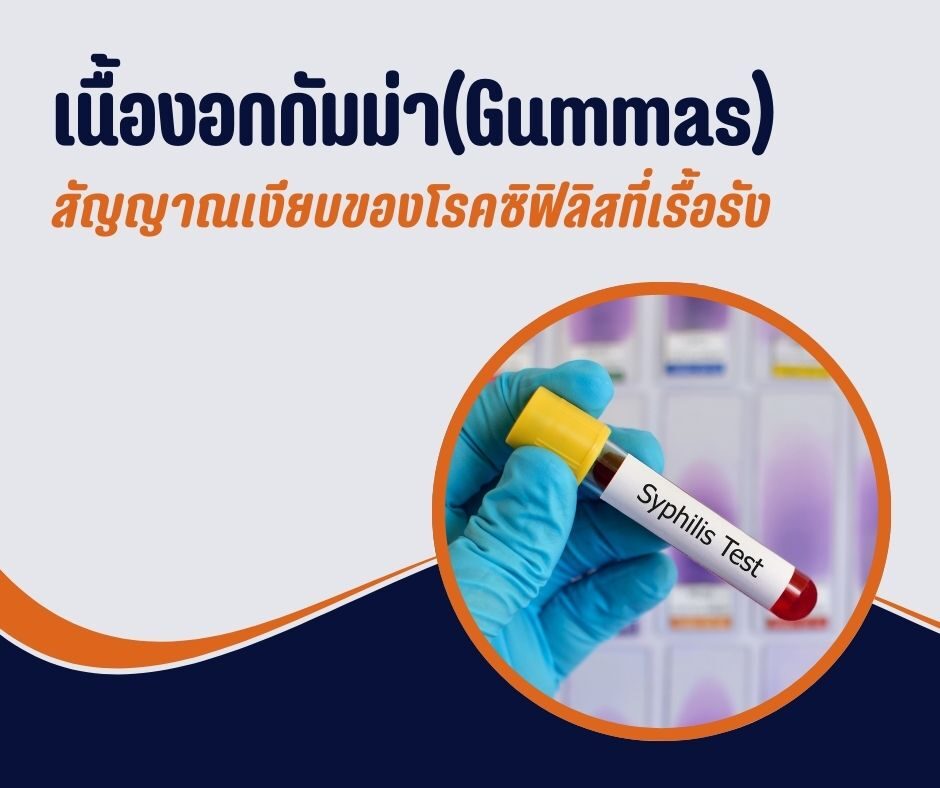 เนื้องอกกัมม่า (Gummas) สัญญาณเงียบของโรคซิฟิลิสที่เรื้อรัง