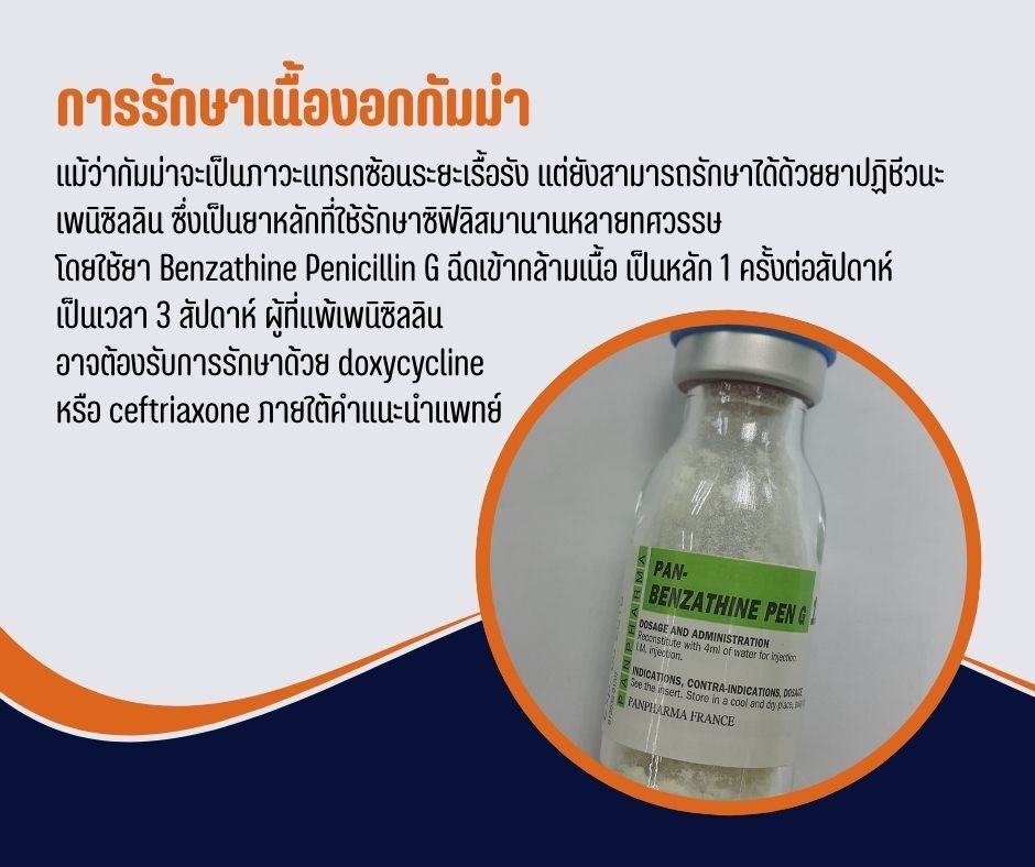 การรักษาเนื้องอกกัมม่า