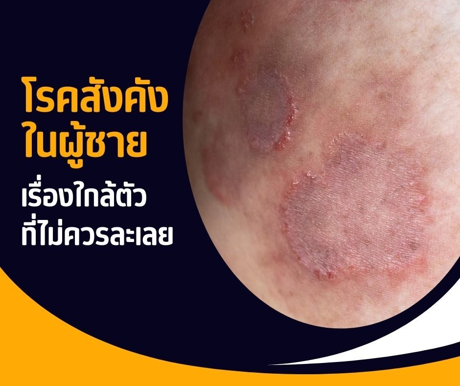 โรคสังคังในผู้ชาย เรื่องใกล้ตัวที่ไม่ควรละเลย