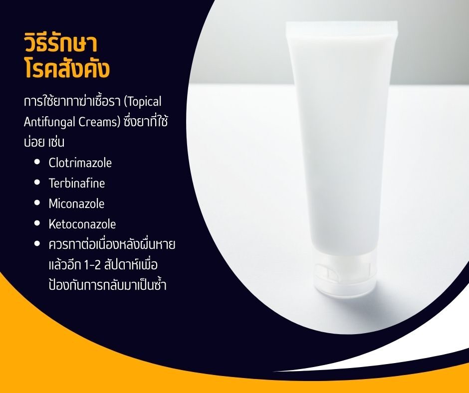 วิธีรักษาโรคสังคัง
