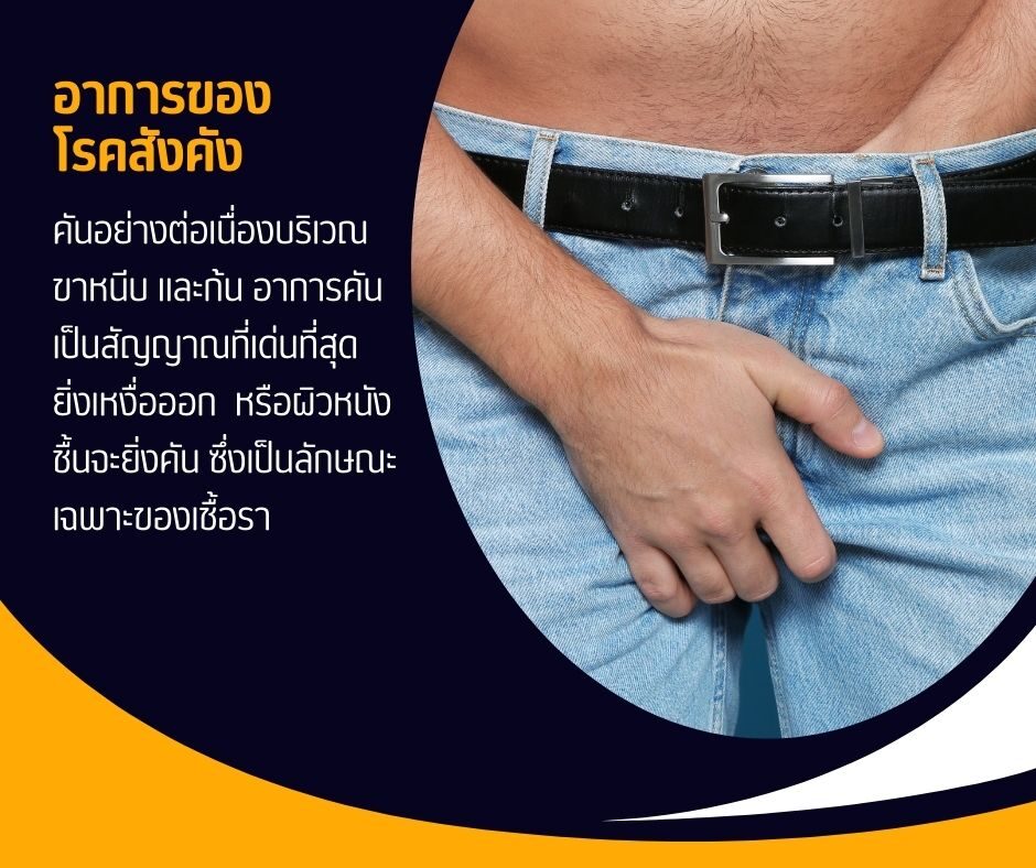 อาการของโรคสังคัง