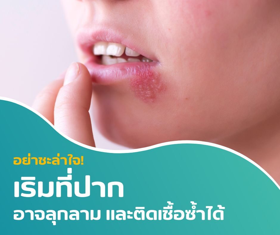 อย่าชะล่าใจ! เริมที่ปากอาจลุกลาม และติดเชื้อซ้ำได้
