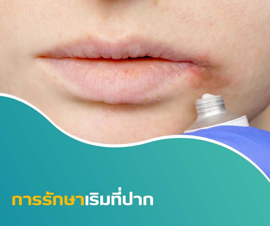 การรักษาเริมที่ปาก