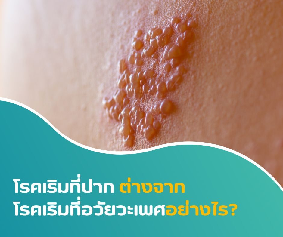 โรคเริมที่ปาก ต่างจากโรคเริมที่อวัยวะเพศอย่างไร