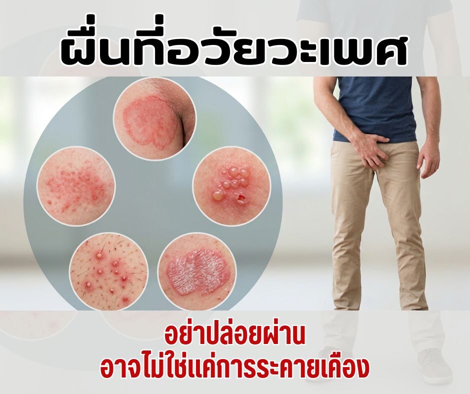 ผื่นที่อวัยวะเพศ อย่าปล่อยผ่าน อาจไม่ใช่แค่การระคายเคือง