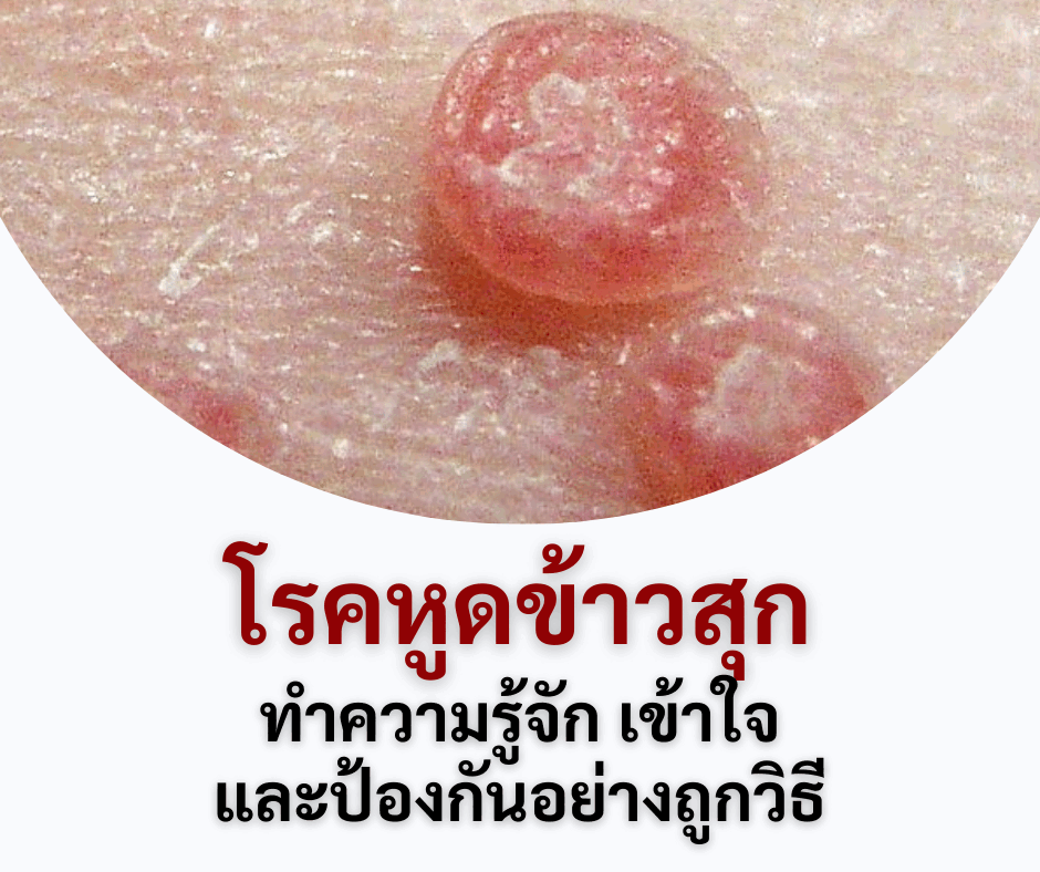 โรคหูดข้าวสุก : ทำความรู้จัก เข้าใจ และป้องกันอย่างถูกวิธี