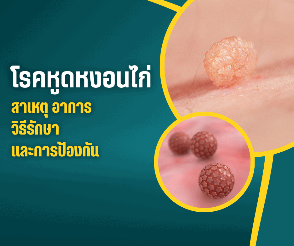 โรคหูดหงอนไก่ : สาเหตุ อาการ วิธีรักษา และการป้องกัน