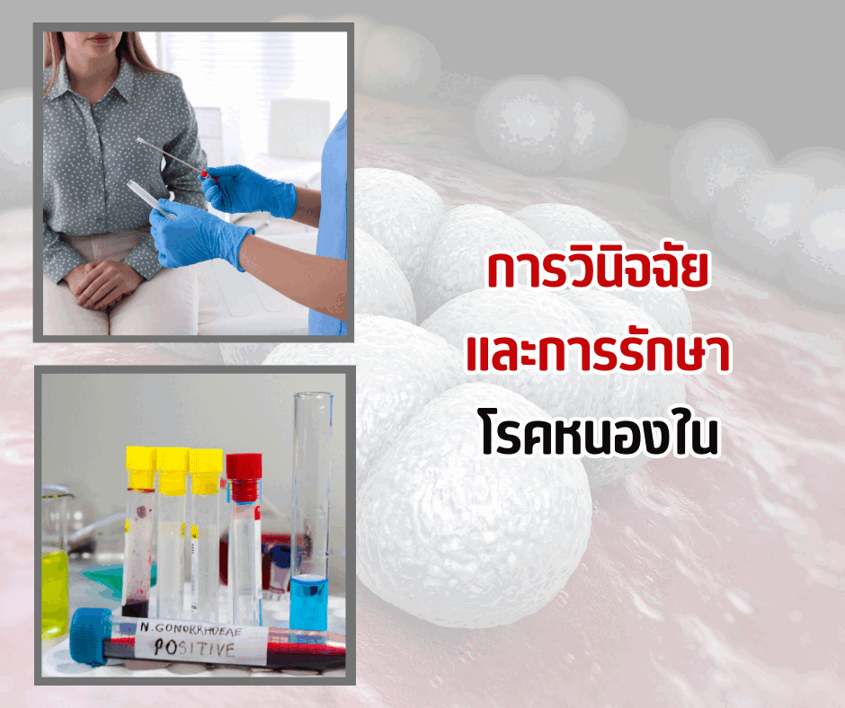 การวินิจฉัยและการรักษาโรคหนองใน