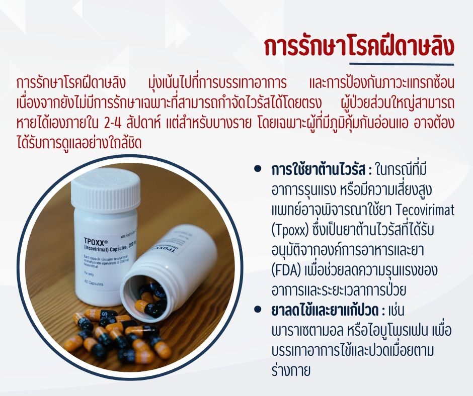 การรักษาโรคฝีดาษลิง