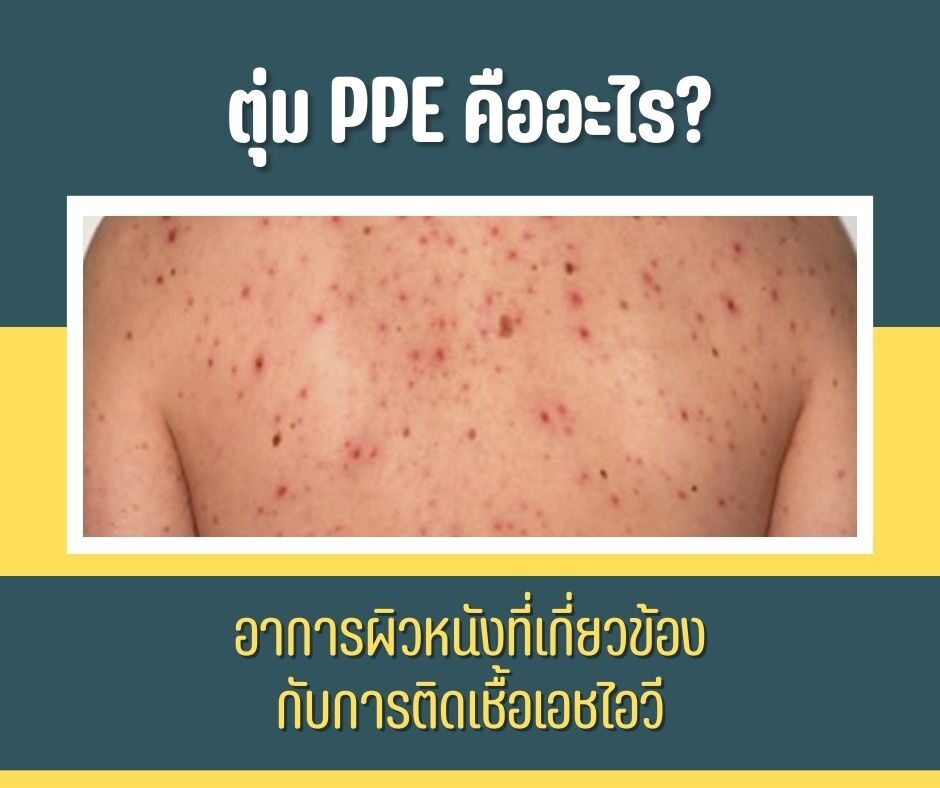 ตุ่ม PPE คืออะไร? อาการผิวหนังที่เกี่ยวข้องกับการติดเชื้อเอชไอวี