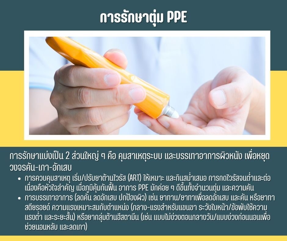 การรักษาตุ่ม PPE