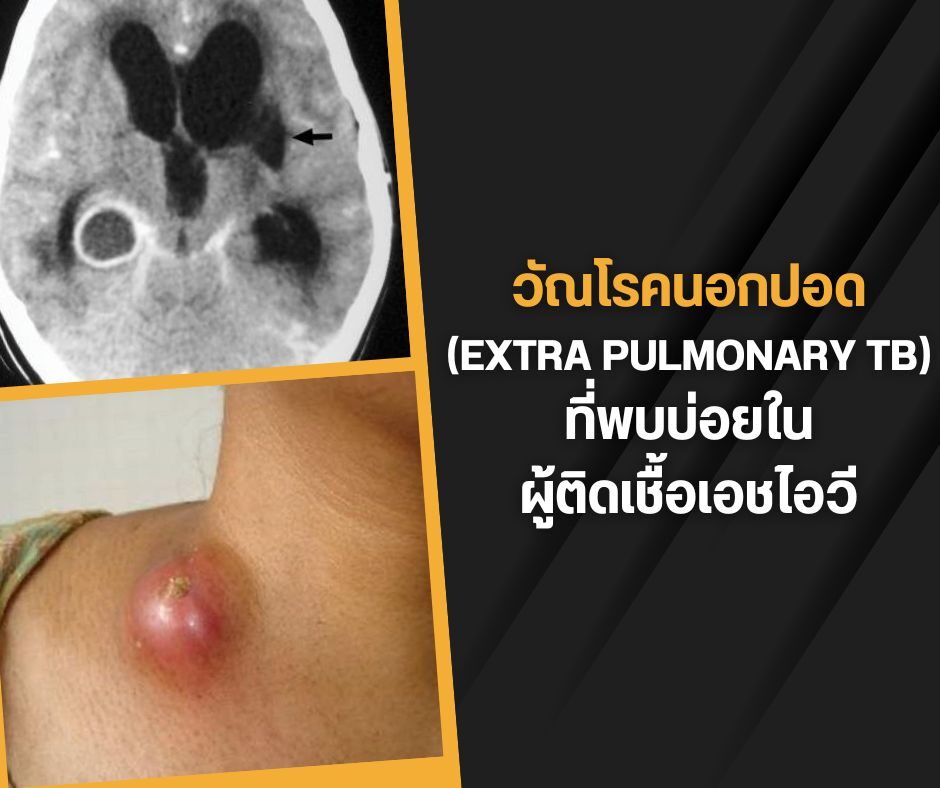 วัณโรคนอกปอด (Extrapulmonary TB) ที่พบบ่อยในผู้ติดเชื้อเอชไอวี