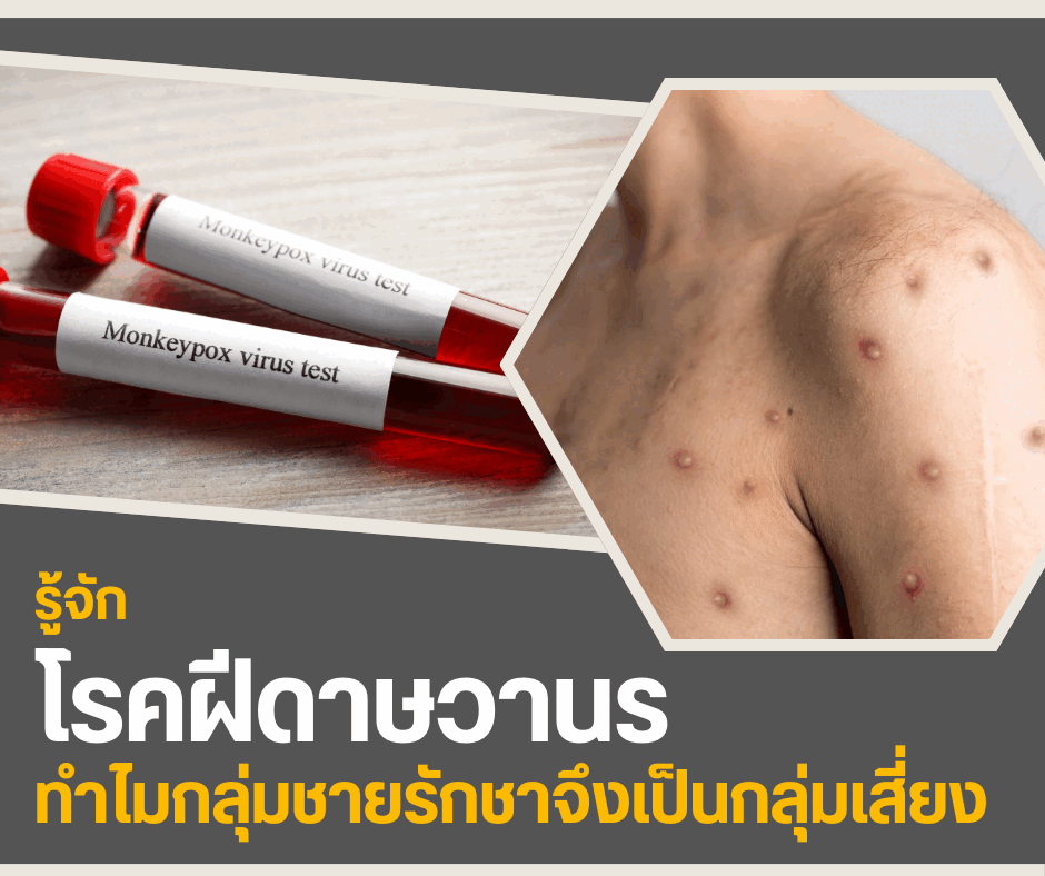 รู้จักโรคฝีดาษวานร ทำไมกลุ่มชายรักชายจึงเป็นกลุ่มเสี่ยง