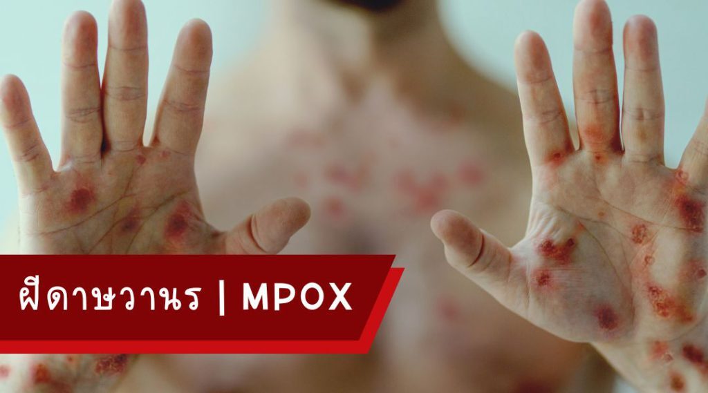 ฝีดาษวานร | Mpox