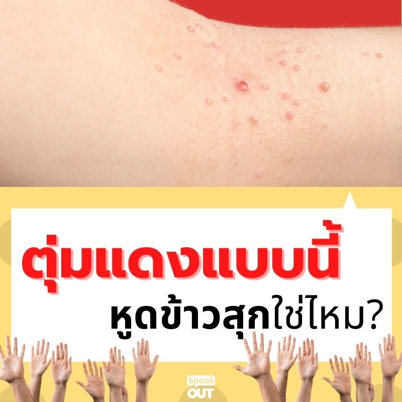 ตุ่มแดงแบบนี้ หูดข้าวสุกใช่ไหม+++++++++++++----❓