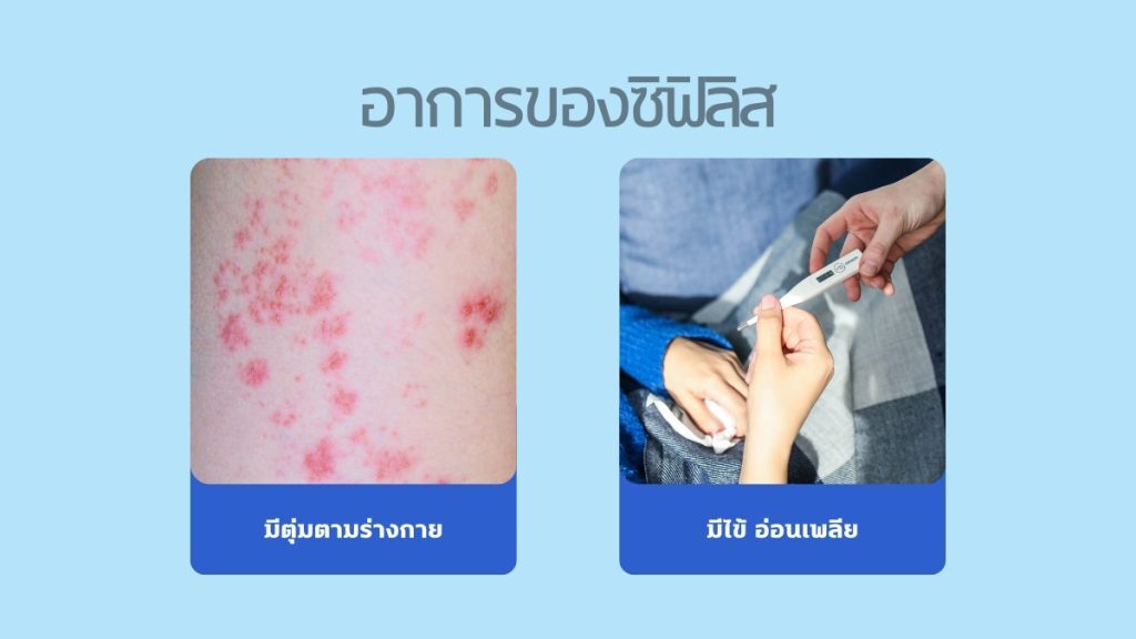 ตุ่มซิฟิลิส มีลักษณะอย่างไร?