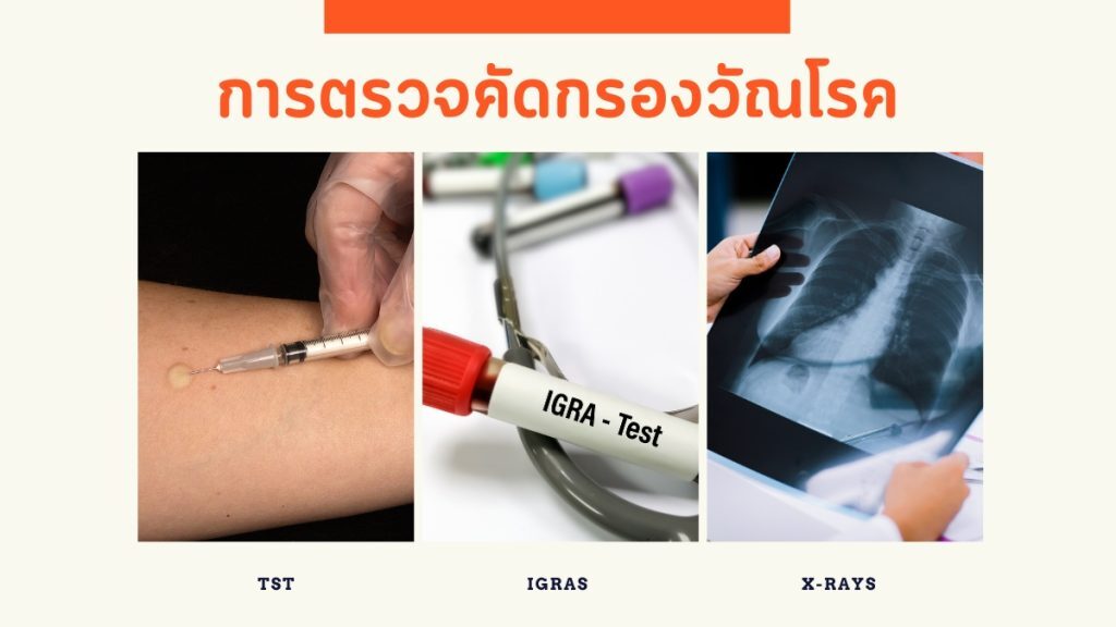 กลยุทธ์ป้องกันวัณโรคในผู้ติดเชื้อเอชไอวี