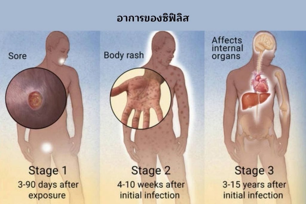 อาการของซิฟิลิส